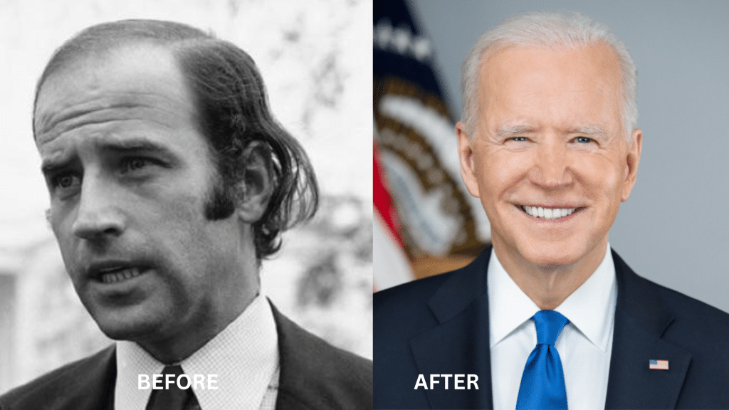 Joe Biden's Hair Transplant & Hair Procedures