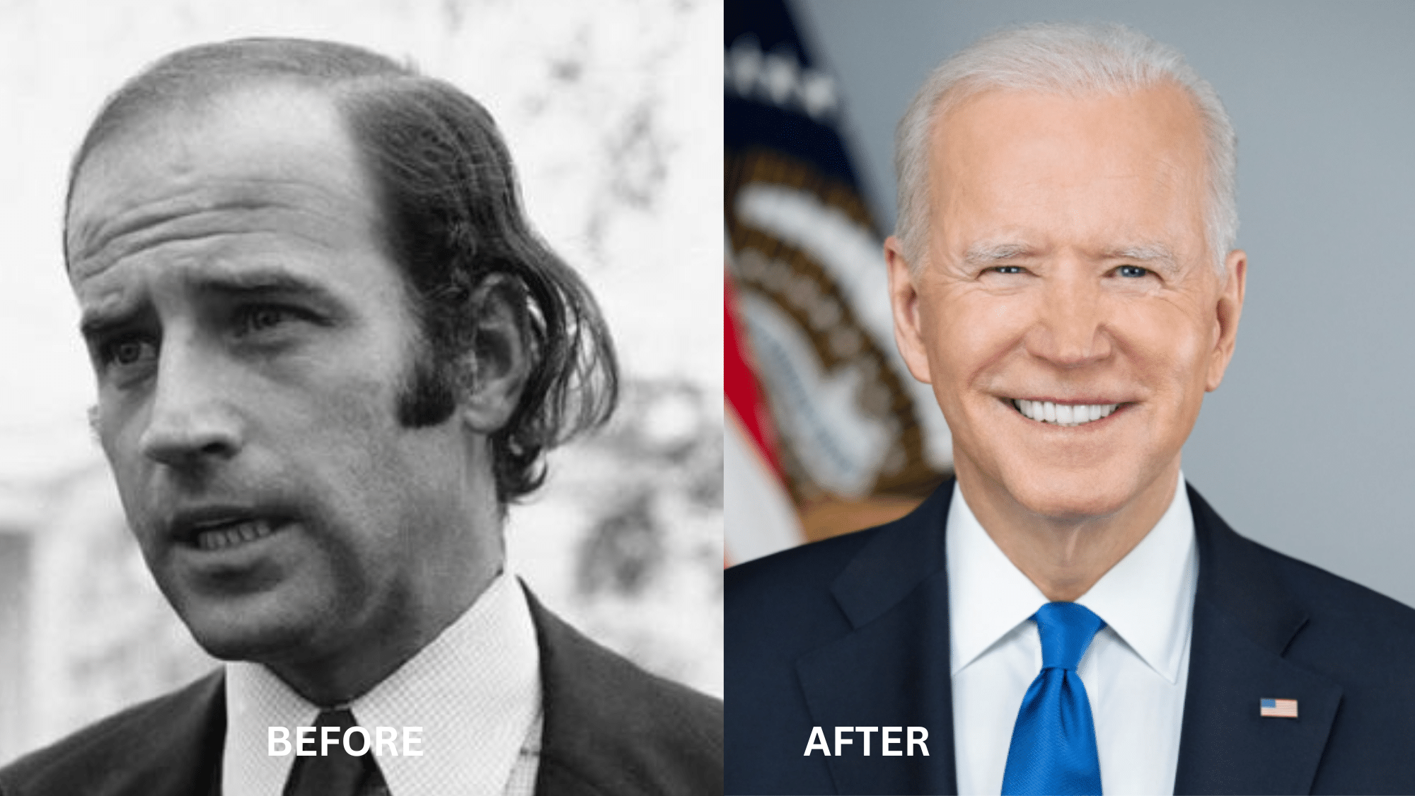Joe Biden's Hair Transplant & Hair Procedures
