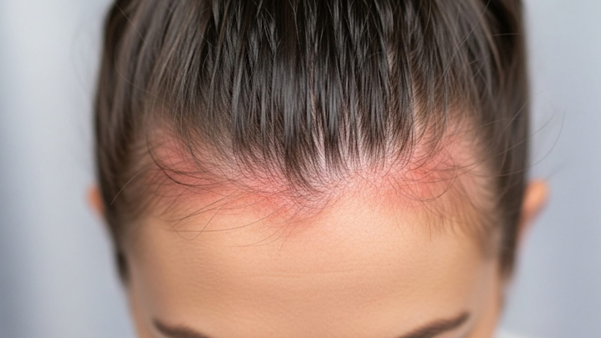 Risks Associated with Tight Hairstyles