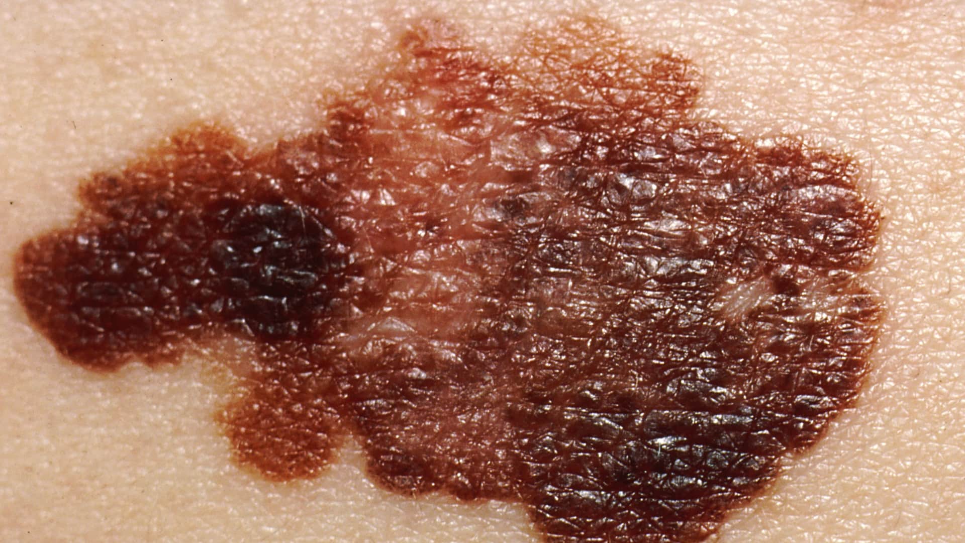 Close-up of melanoma skin cancer on a person’s neck showing a dark, irregular mole with uneven edges and color variation
