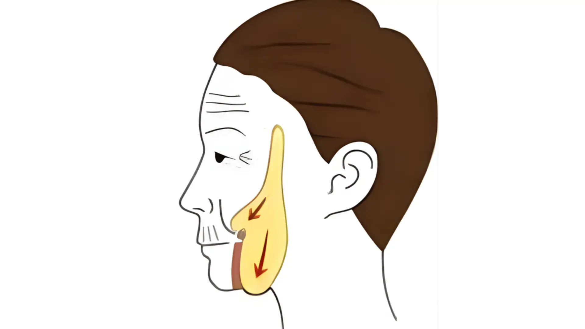 Side profile illustration showing cheek fat pad anatomy with directional arrows