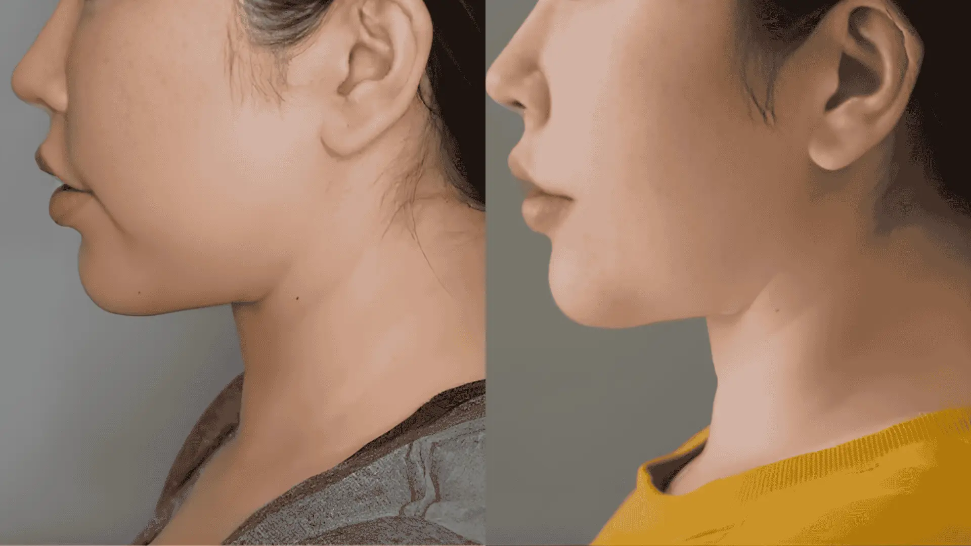 Profile view of a woman's face before and after jawline surgery in side-by-side comparison