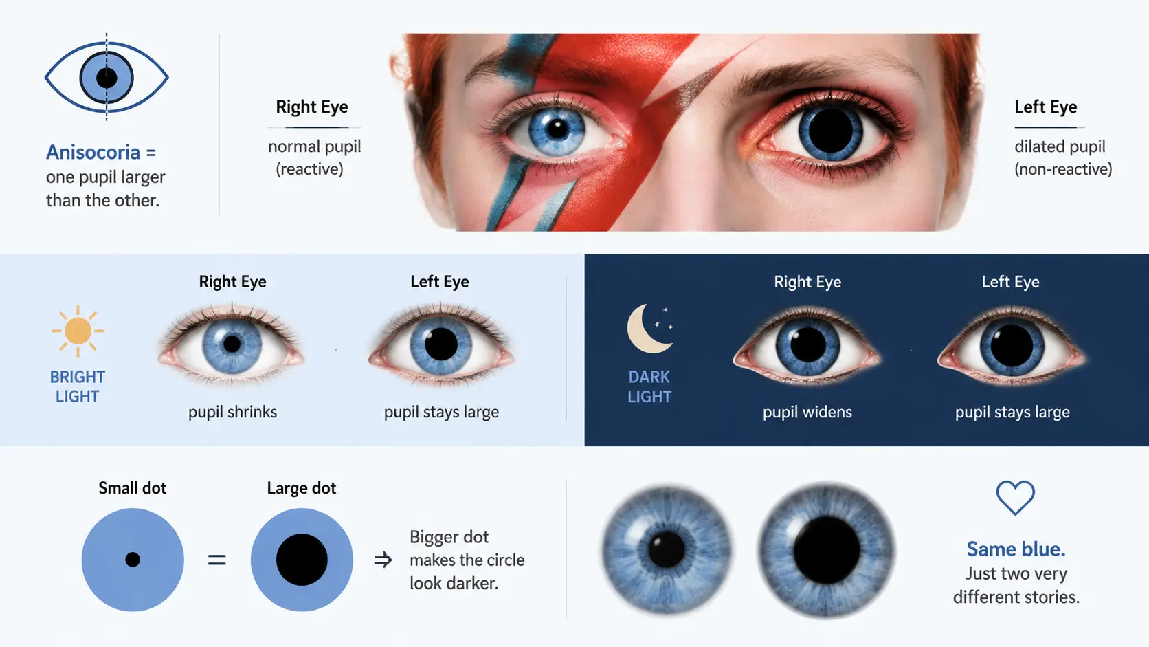 Infographic explaining anisocoria, showing the difference between a normal and dilated pupil with a comparison analogy