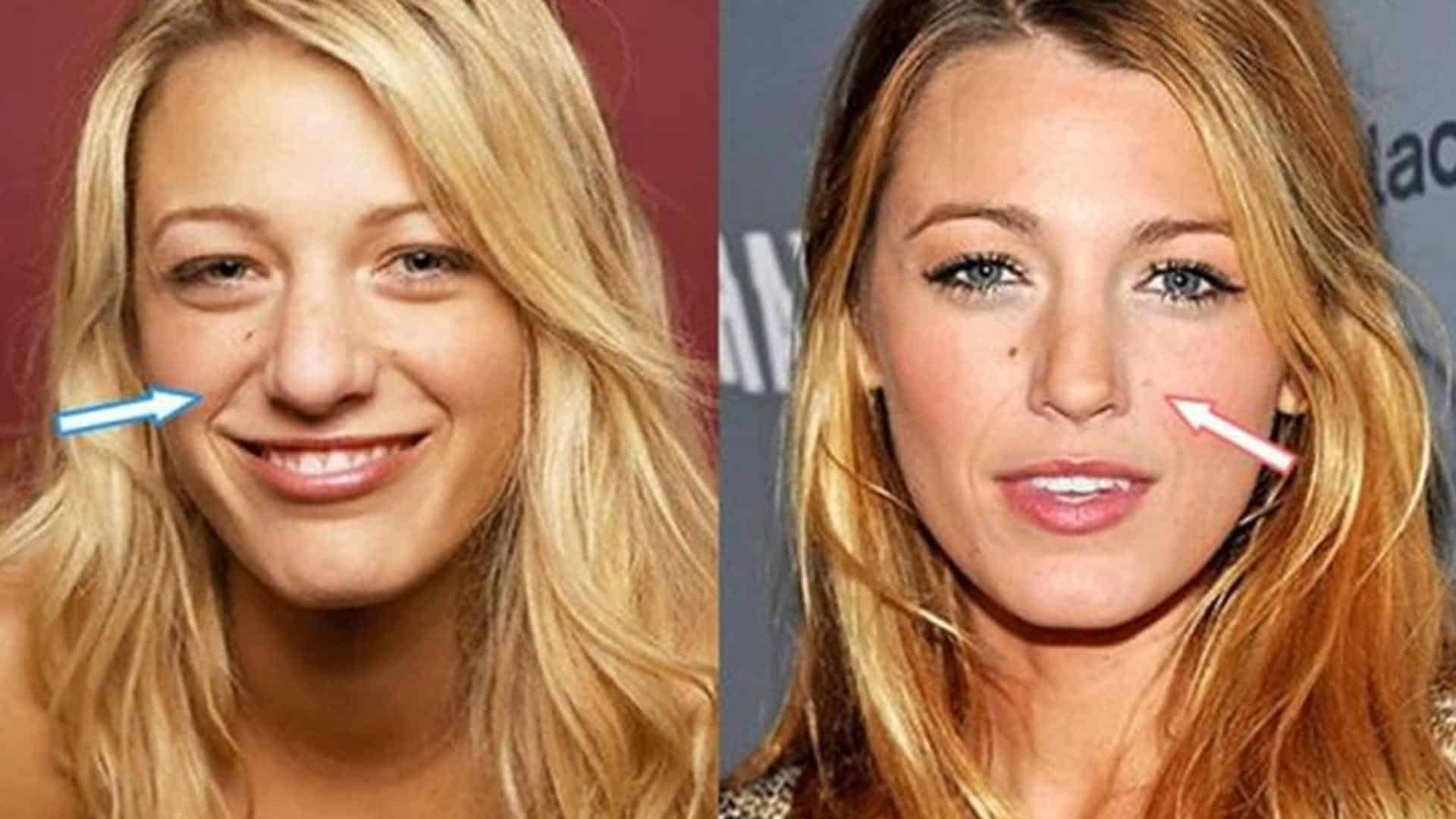 Side-by-side photos of Blake Lively showing early and recent nose shape comparison with arrows pointing