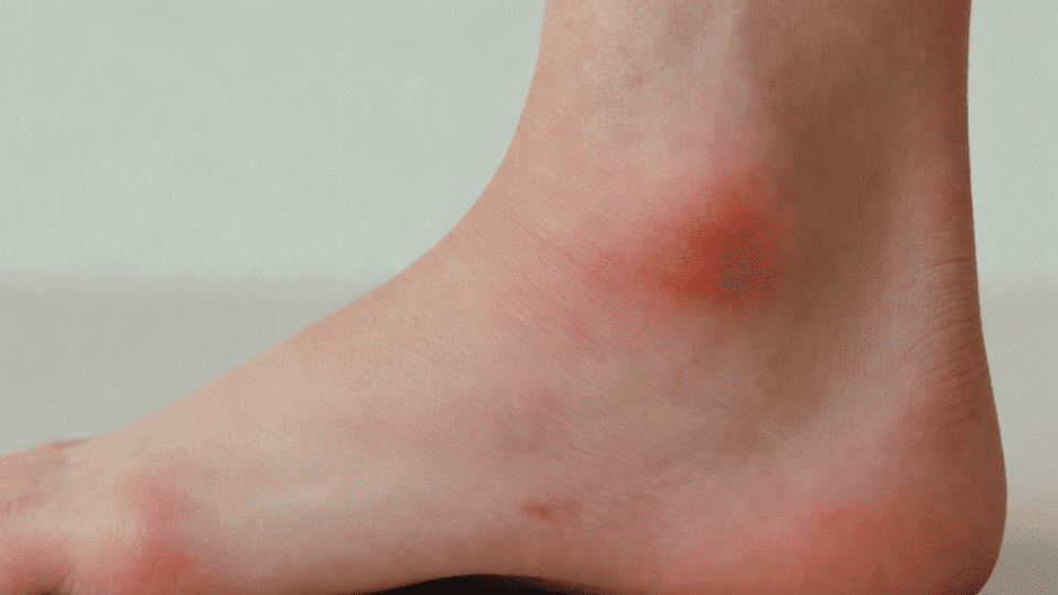 How to Recognize Cuboid Syndrome and Treat it Effectively