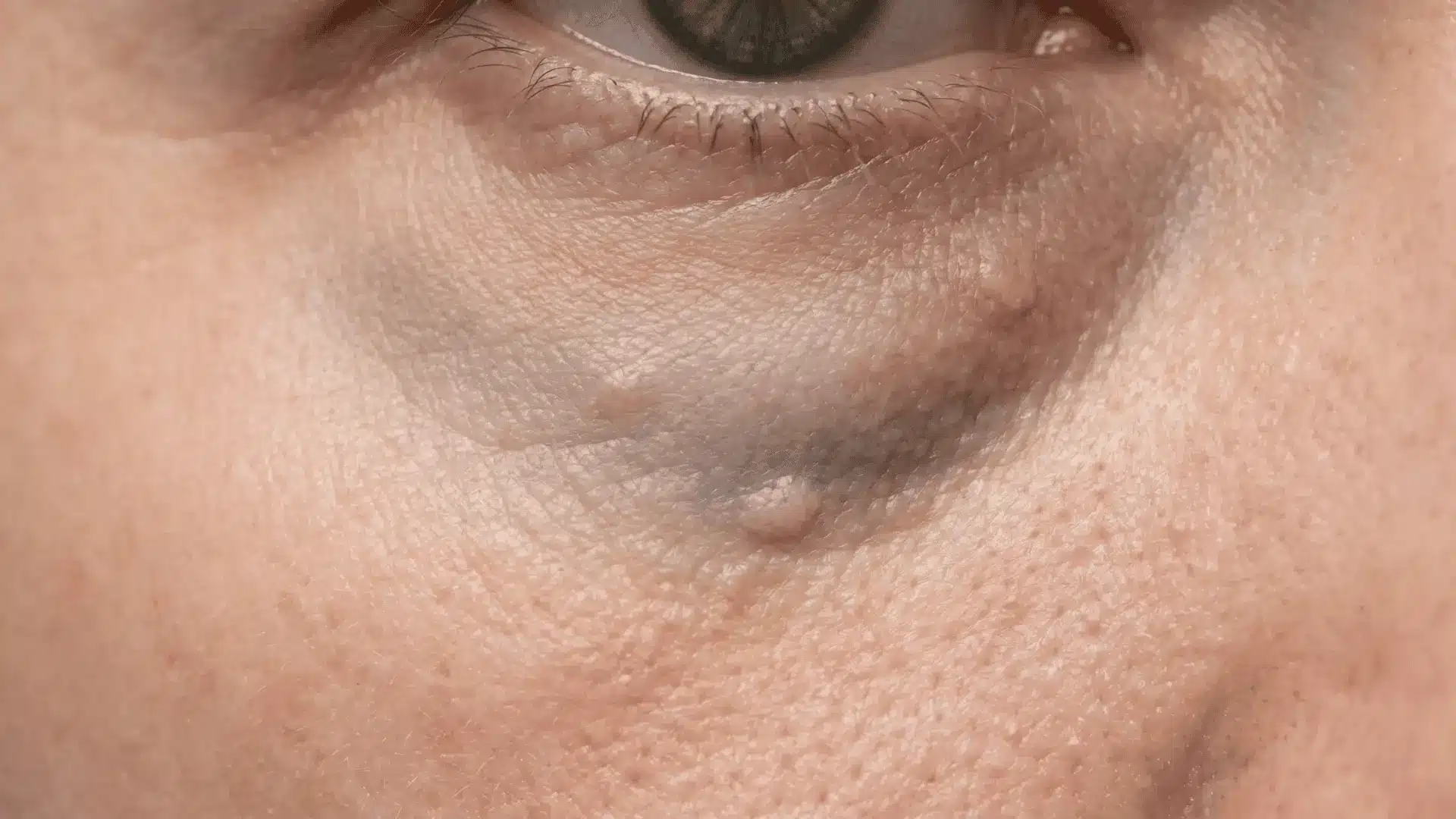 Under-eye skin with puffiness, blue-gray discoloration, and small palpable lumps