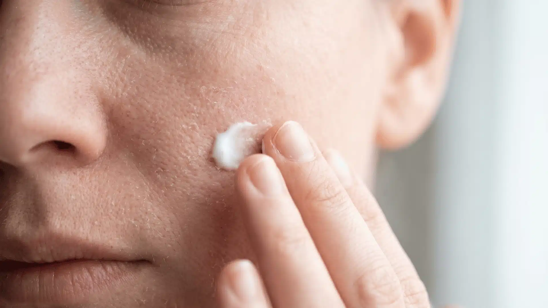Person applying a small amount of tretinoin cream to the face, demonstrating proper application during a purge.