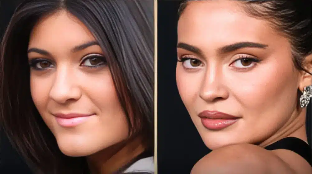 Kylie Jenner Before and After Lip Fillers