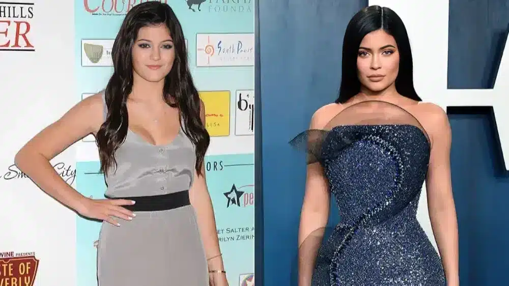 Kylie Jenner Before vs Today
