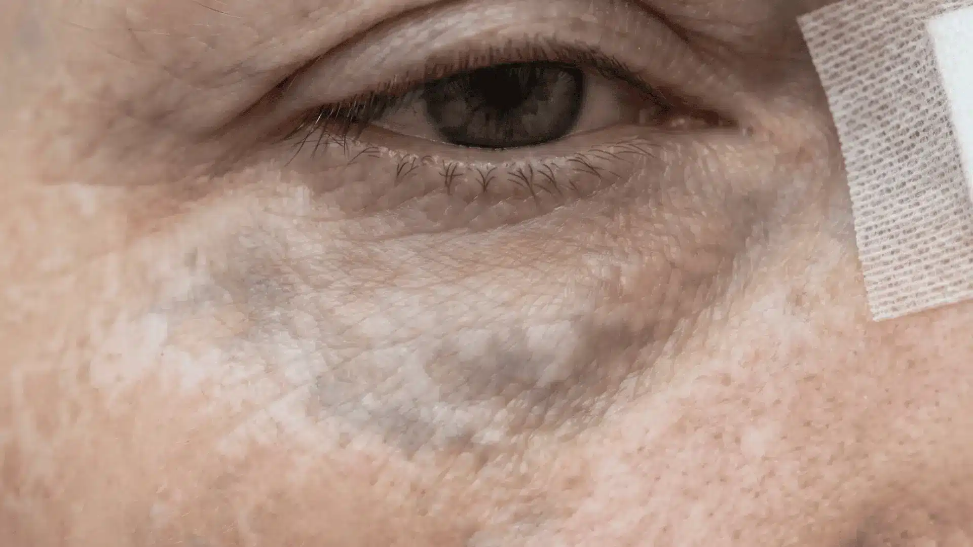 Under-eye skin with patchy white and gray discoloration from vascular occlusion