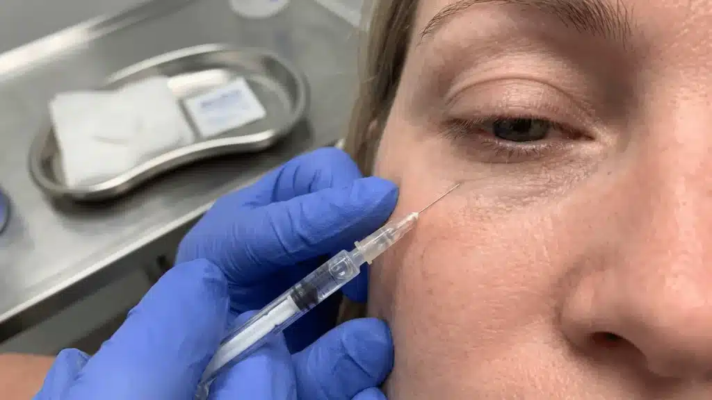 Under-eye area with needle approaching thin skin for filler injection