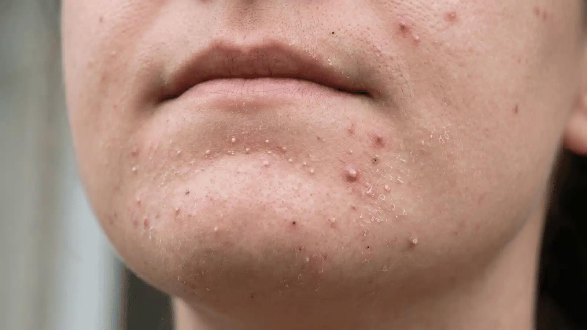 Close-up of acne-prone areas displaying small whiteheads, blackheads, and redness typical of a tretinoin purge.