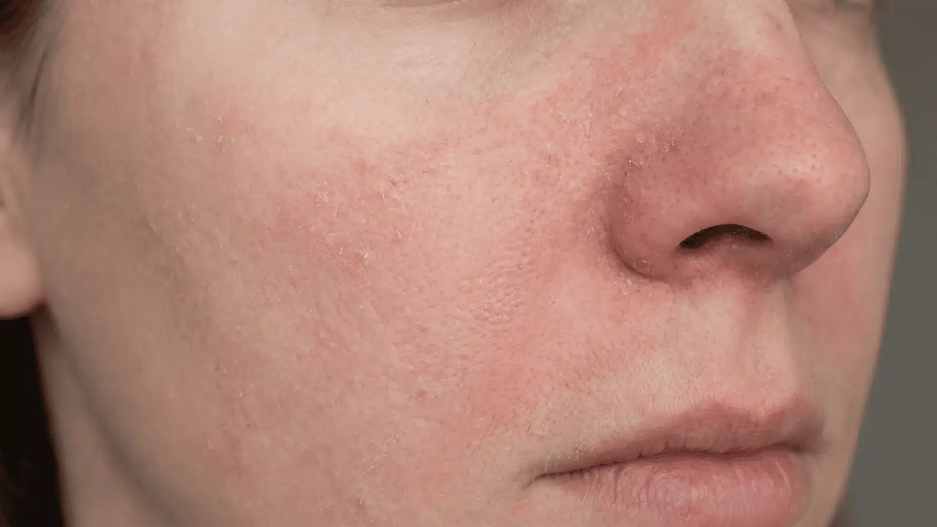 Close-up of face with mild dryness and light flaking from retinol adjustment