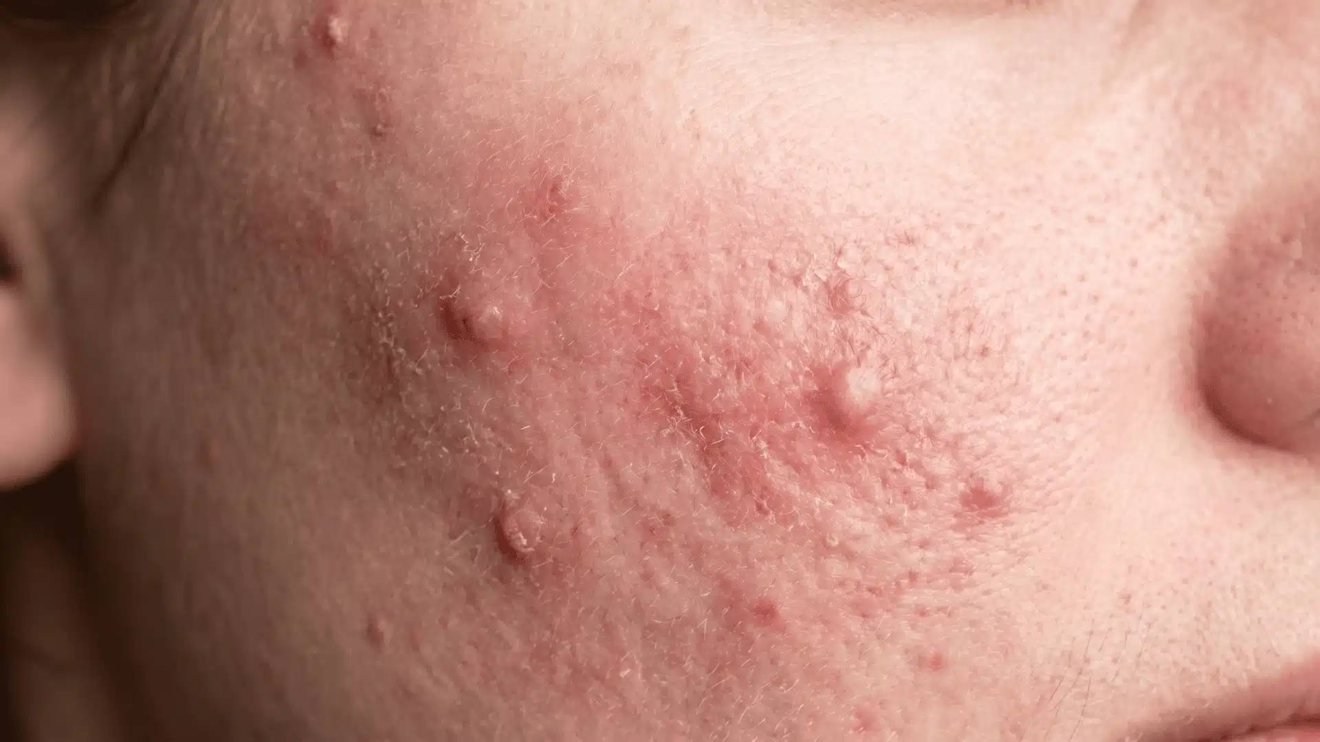 Inflamed and irritated skin indicating barrier damage, distinguishing a problematic reaction from a normal tretinoin purge.
