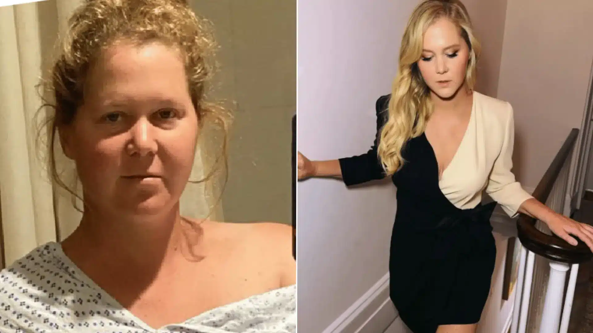 Amy Schumer at an event, featured in a discussion of her decision to speak publicly about having liposuction.