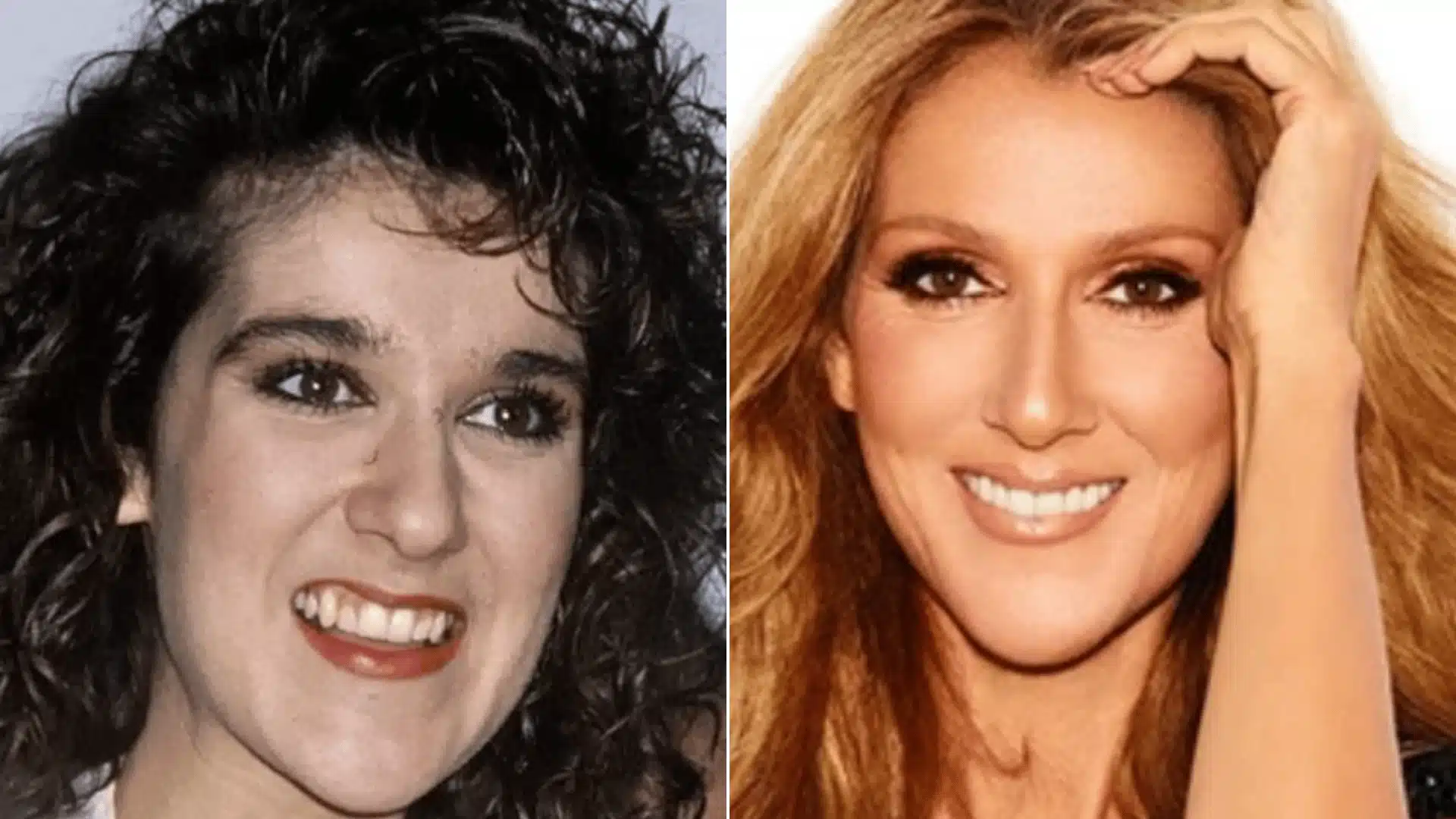 Celine Dion celebrity teeth before and after, showing changes in tooth color, shape, and alignment