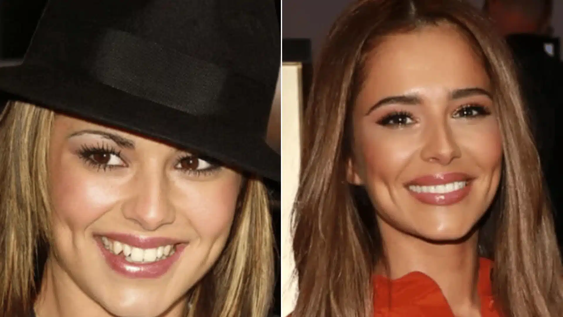 Cheryl Cole in side-by-side portraits, with slightly uneven front teeth before and a fuller, more uniform smile after