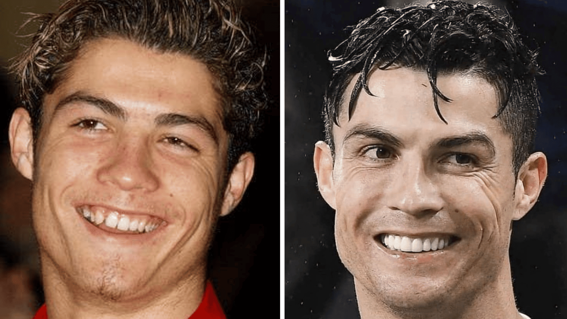 Cristiano Ronaldo before and after dental appearance comparison showing changes in his smile and teeth.
