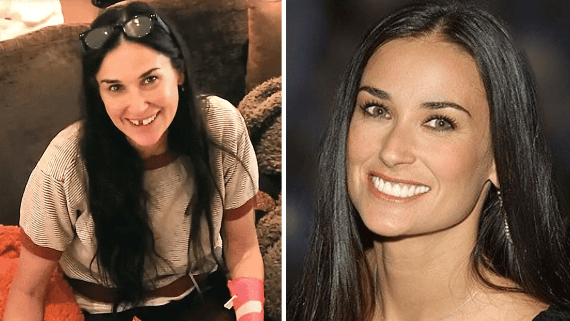 Demi Moore before and after dental appearance comparison showing changes in his smile and teeth.