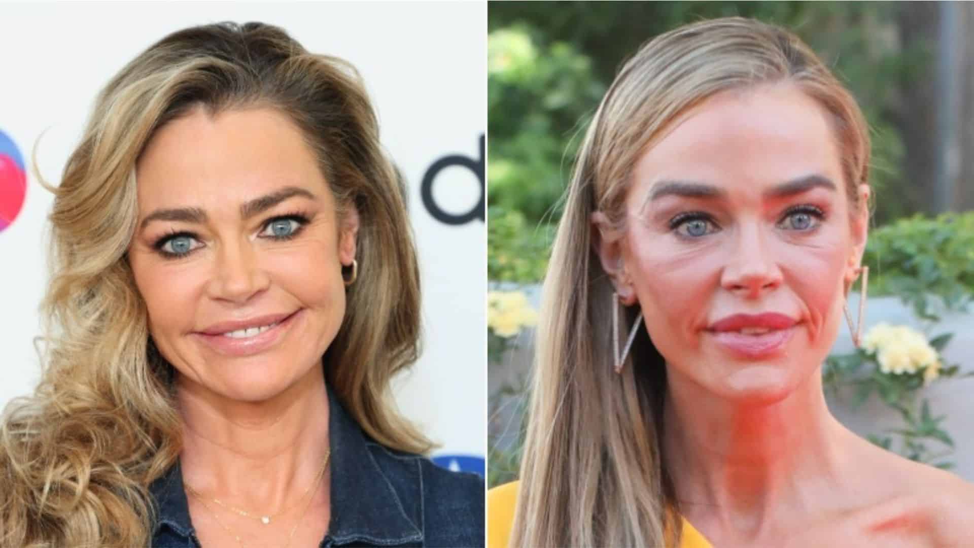 Denise Richards discussing facial surgery including a lip lift procedure
