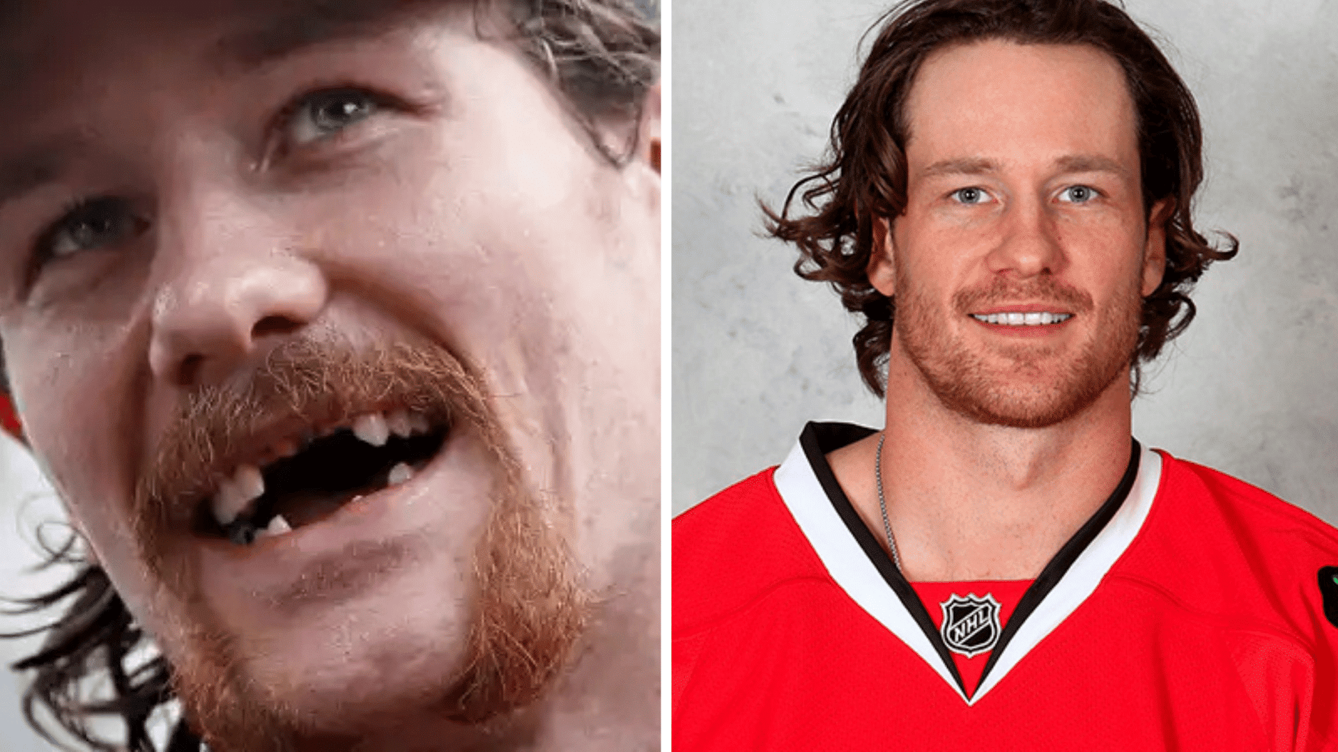 Duncan Keith before and after dental appearance comparison showing changes in his smile and teeth.