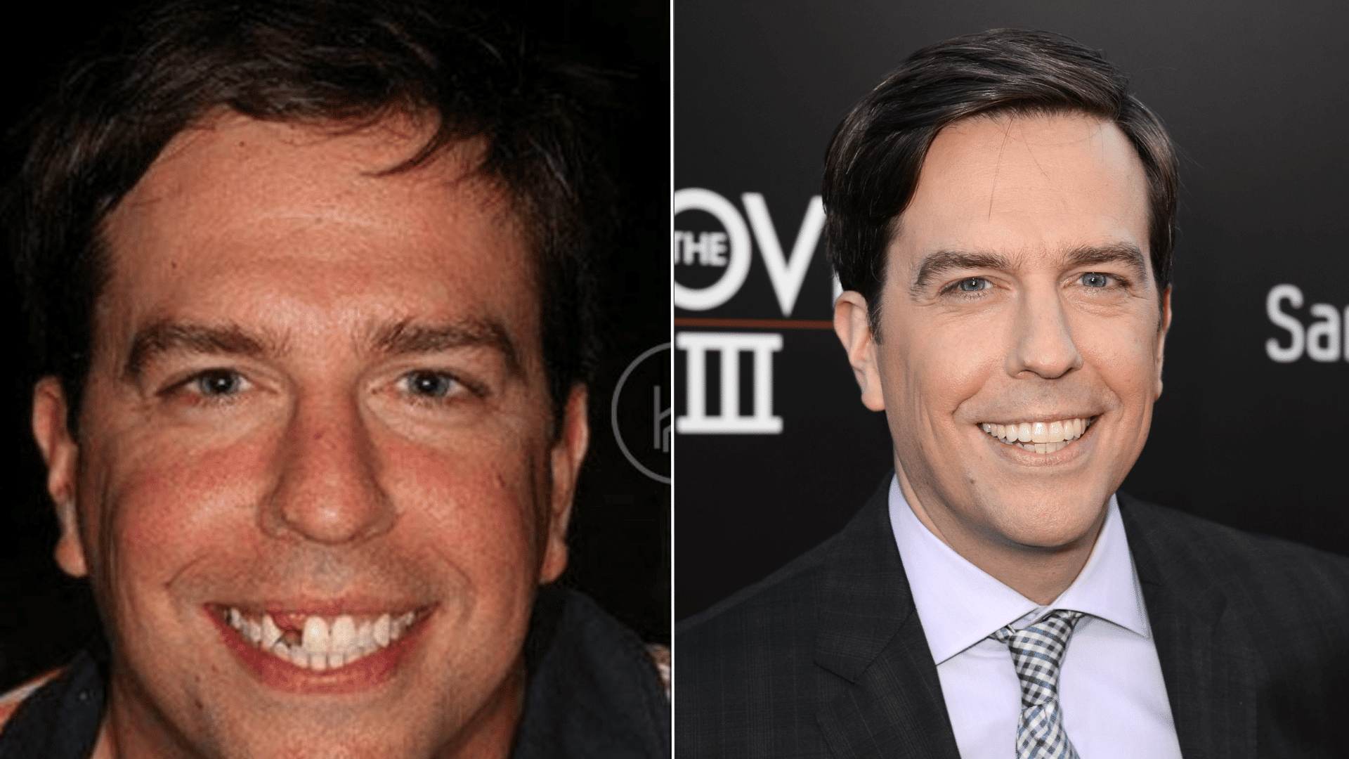 Ed Helms before and after dental appearance comparison showing changes in his smile and teeth.