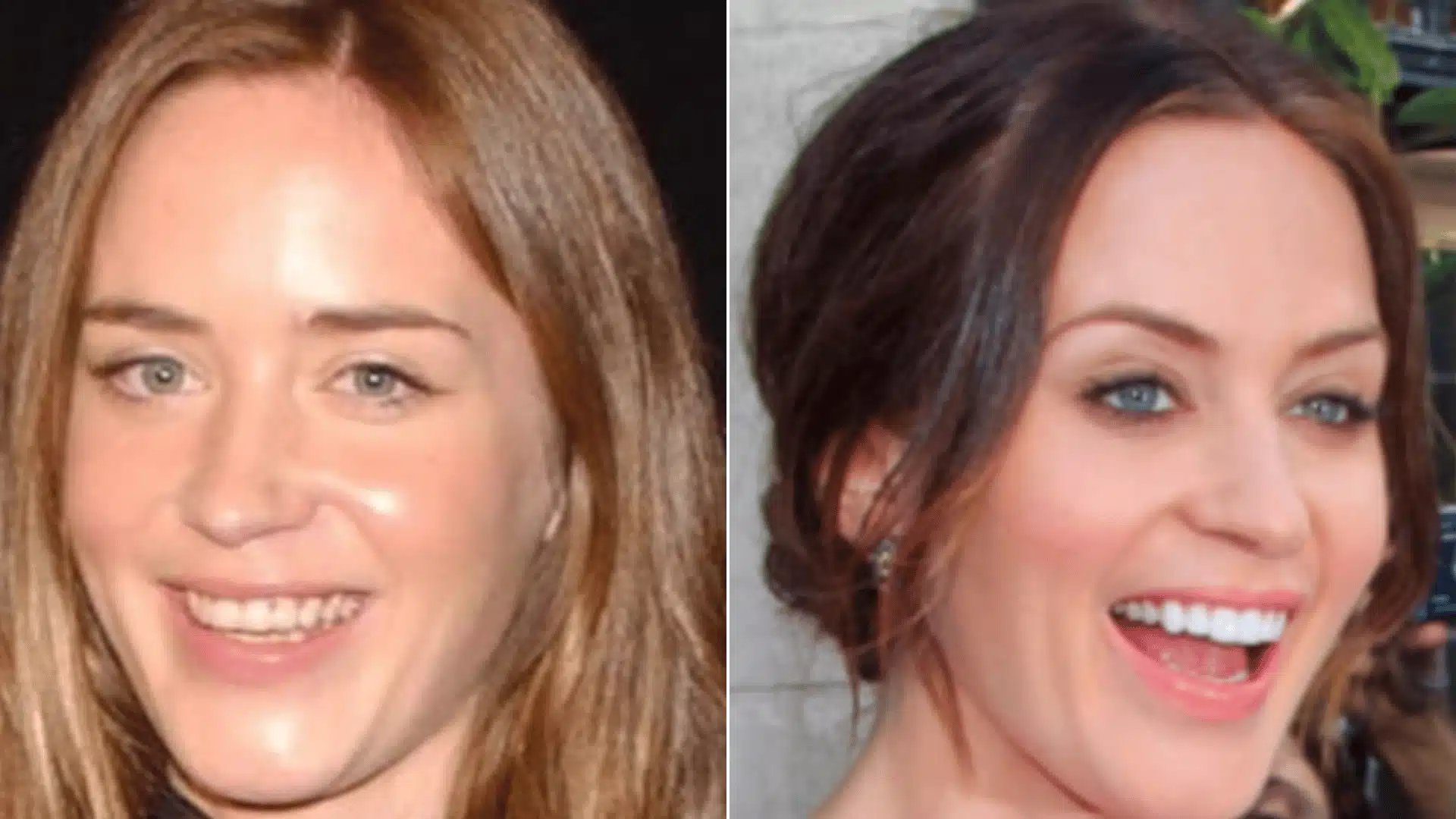 Emily Blunt in paired smiling portraits, with narrower upper teeth on the left and broader, more evenly shaped teeth on the right
