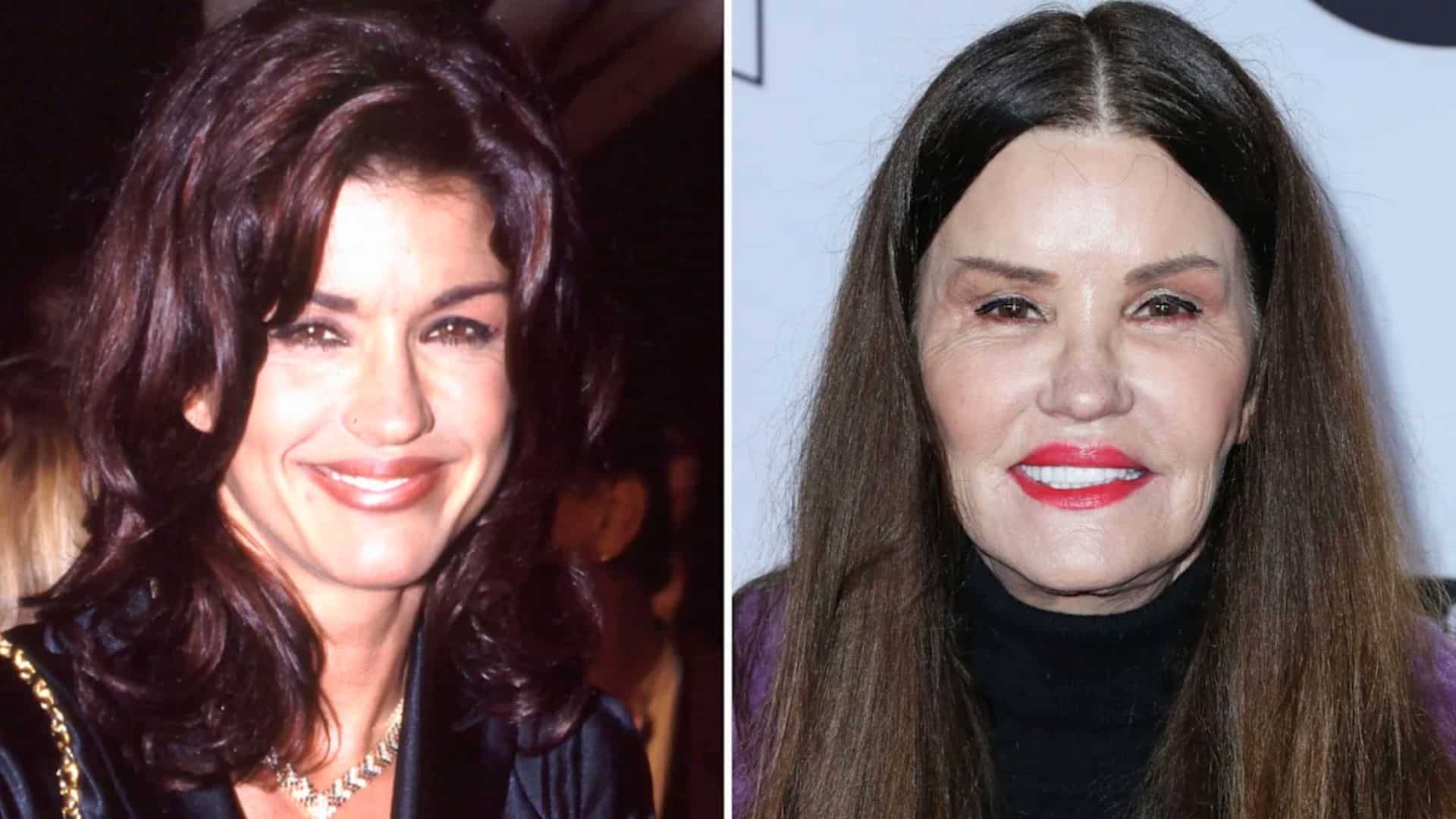 Janice Dickinson’s reported subnasal lip lift as part of facial surgery