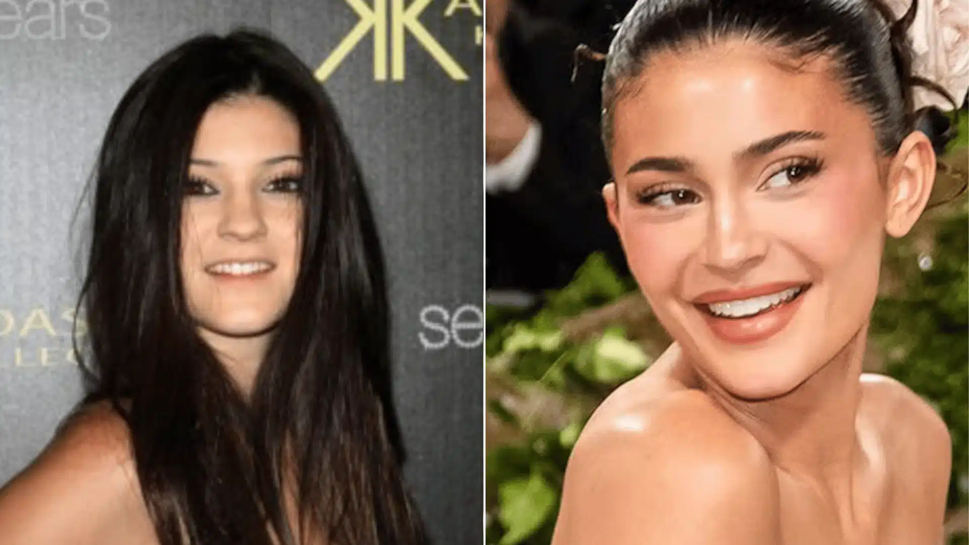 Kylie Jenner in paired portraits, wearing braces on the left and showing a straighter upper tooth line on the right