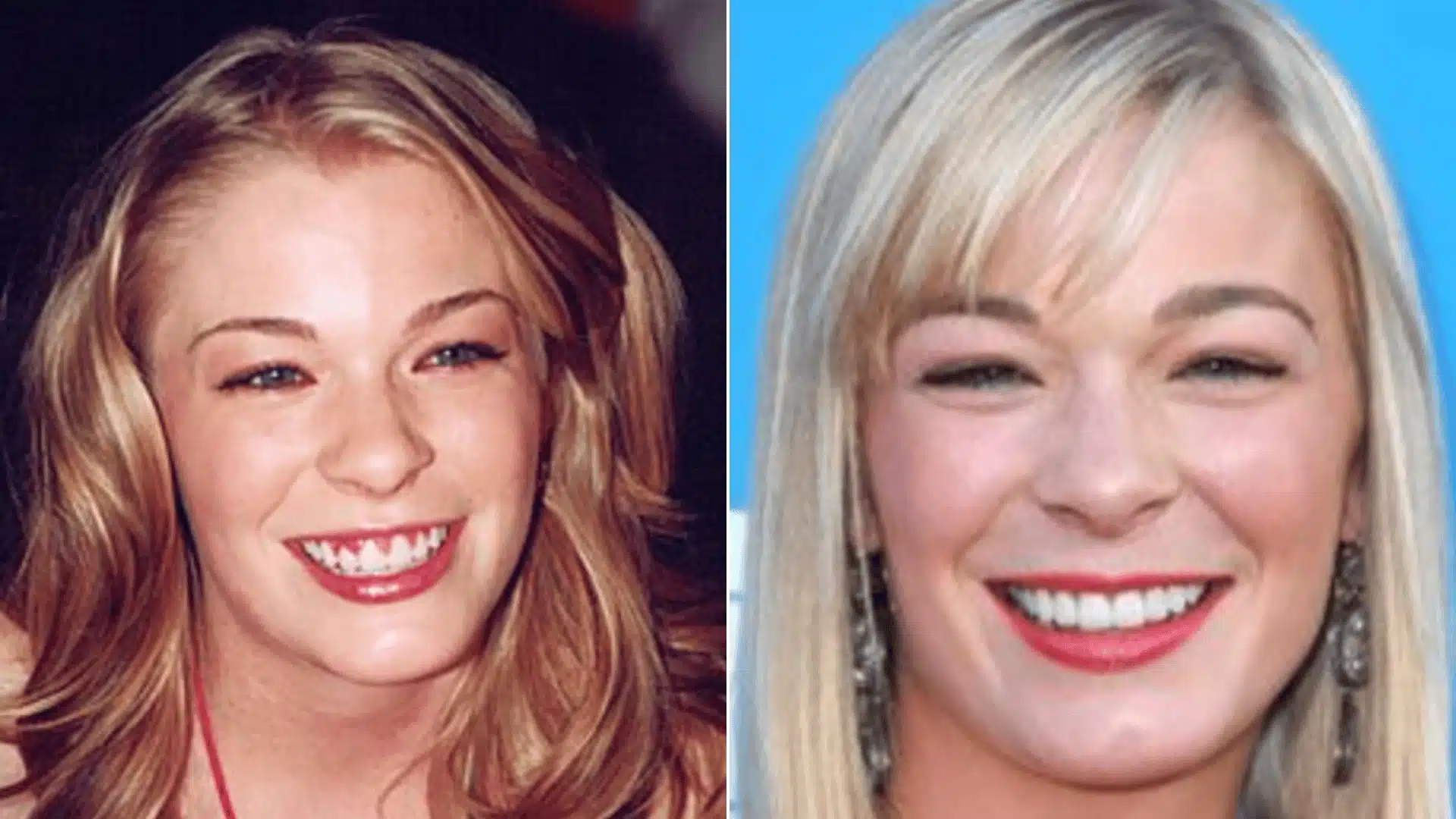 LeAnn Rimes in two smiling portraits, with prominent upper front teeth on the left and a more even tooth line on the right