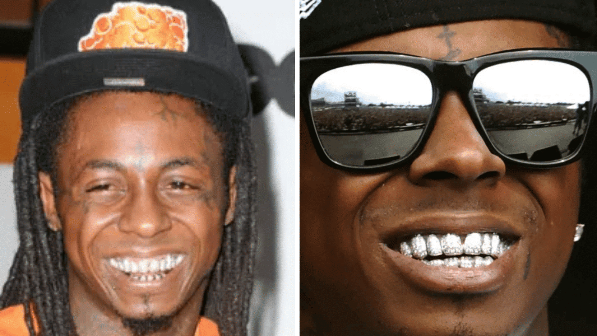 Lil Wayne before and after dental appearance comparison showing changes in his smile and teeth.