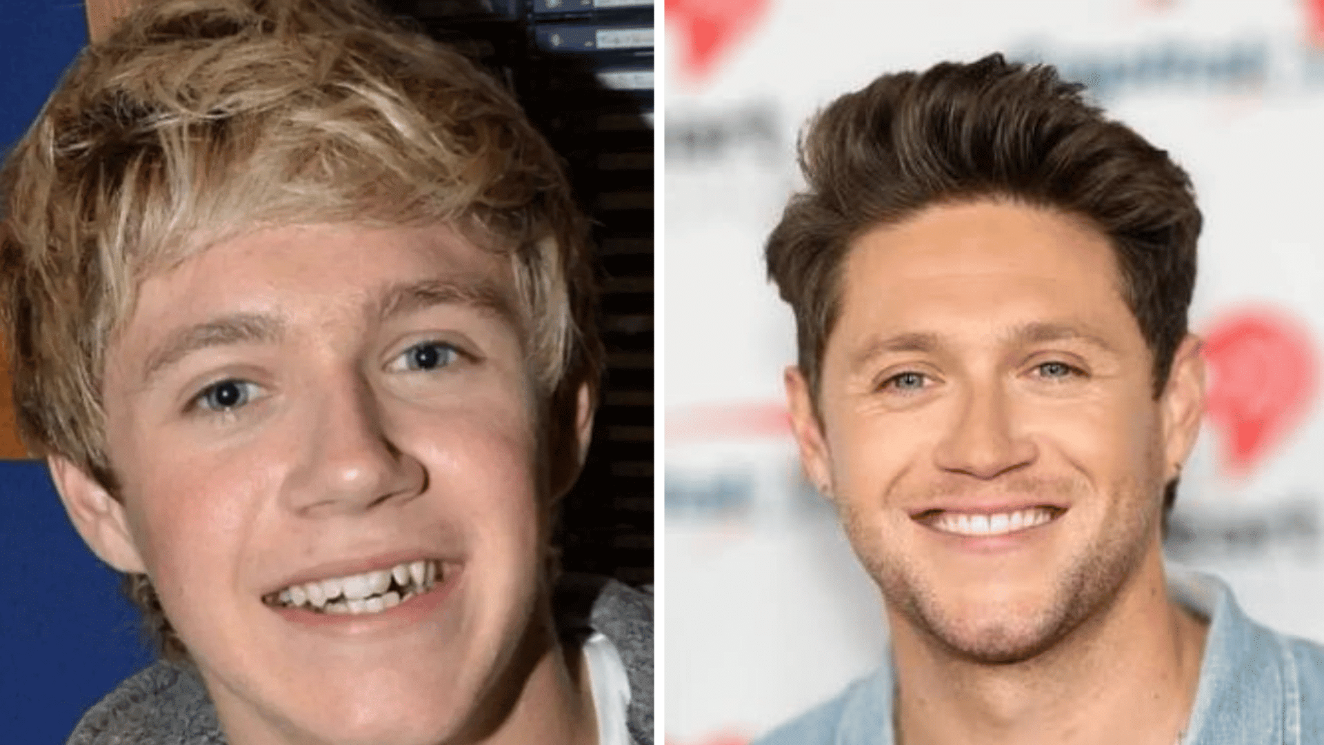 Niall Horan before and after dental appearance comparison showing changes in his smile and teeth.