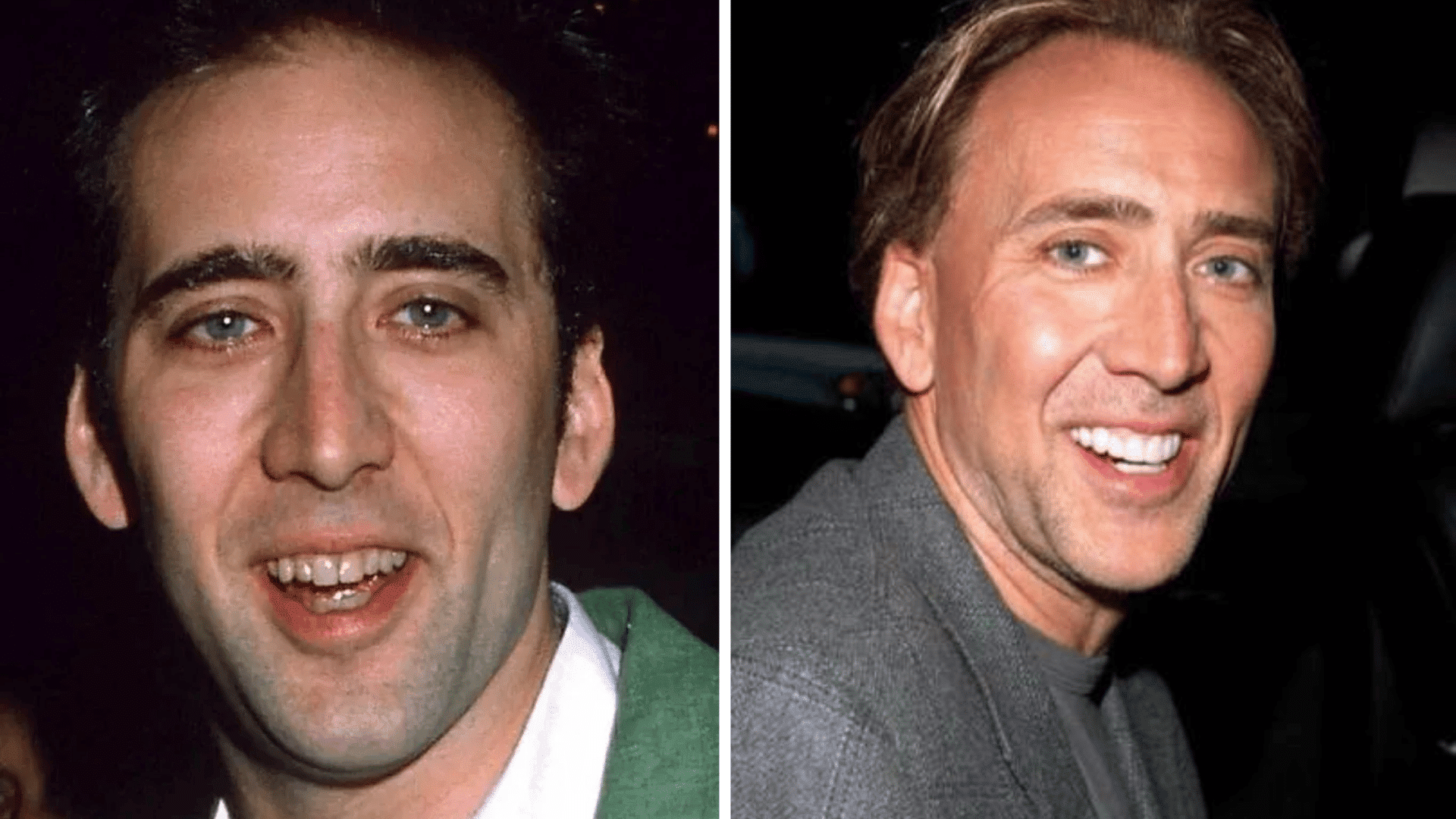 Nicolas Cage before and after dental appearance comparison showing changes in his smile and teeth.