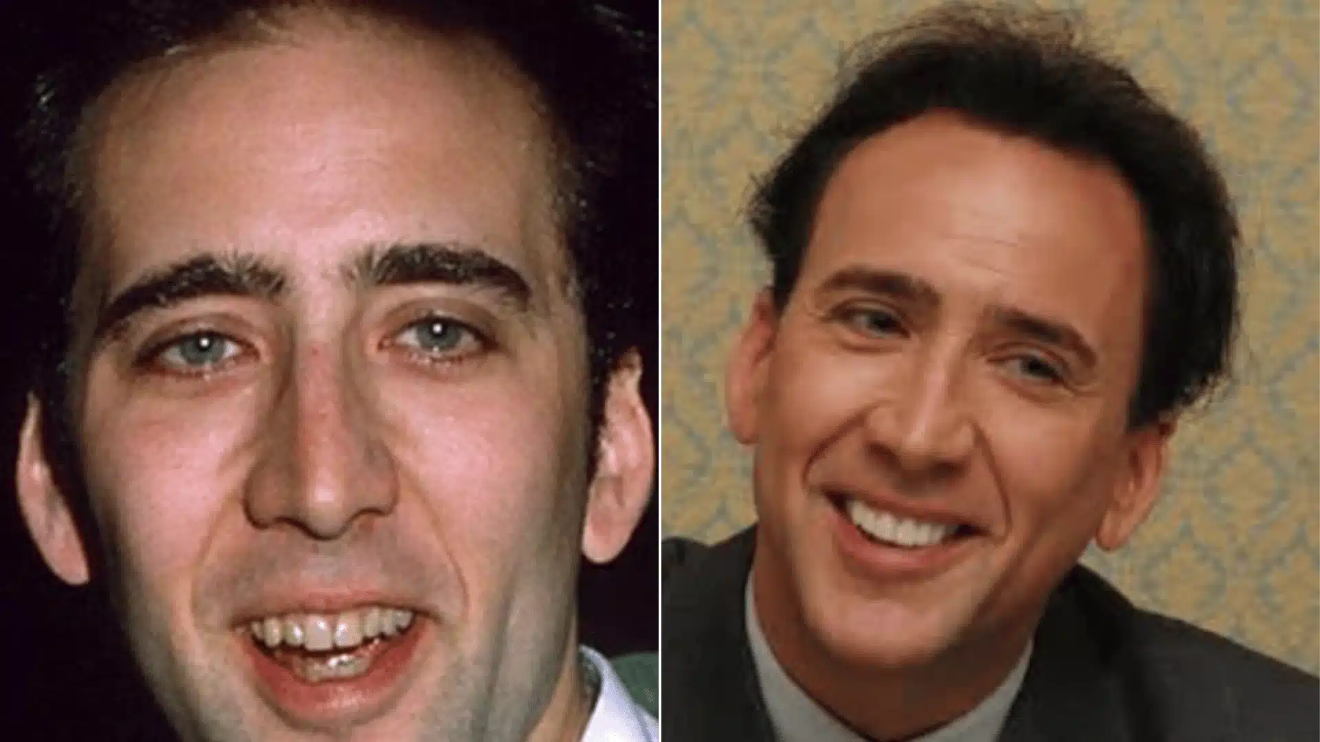 Nicolas Cage in labeled portraits, with a wider gap between his upper front teeth before and more even spacing after