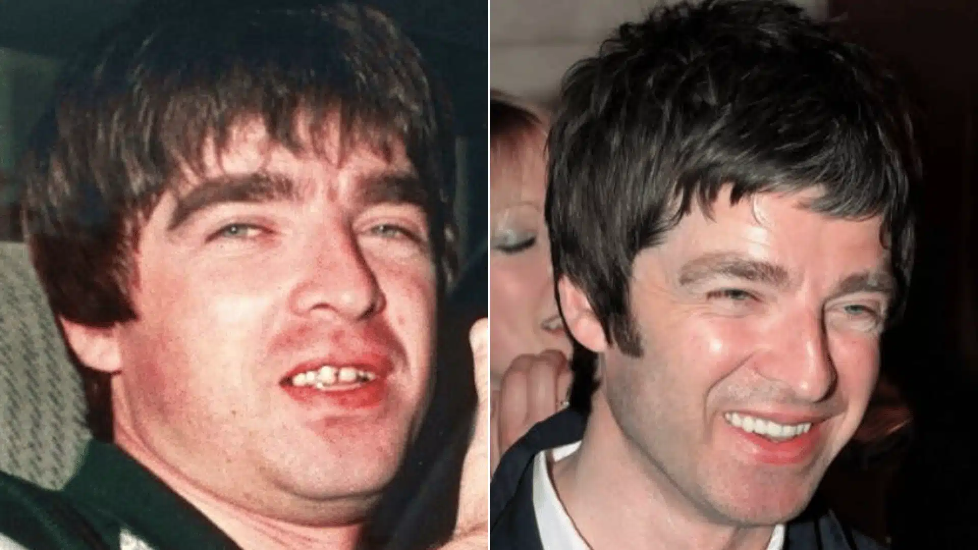 Noel Gallagher in two portraits, with missing and uneven upper teeth on the left and a complete, aligned tooth line on the right