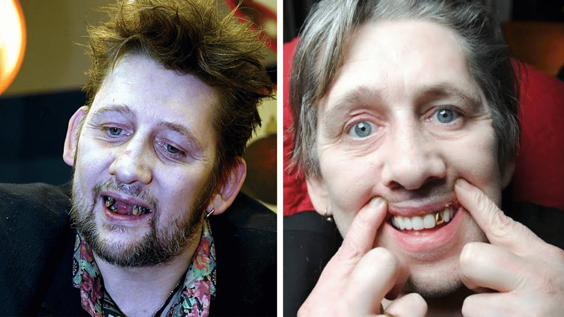 Shane MacGowan before and after dental appearance comparison showing changes in his smile and teeth.