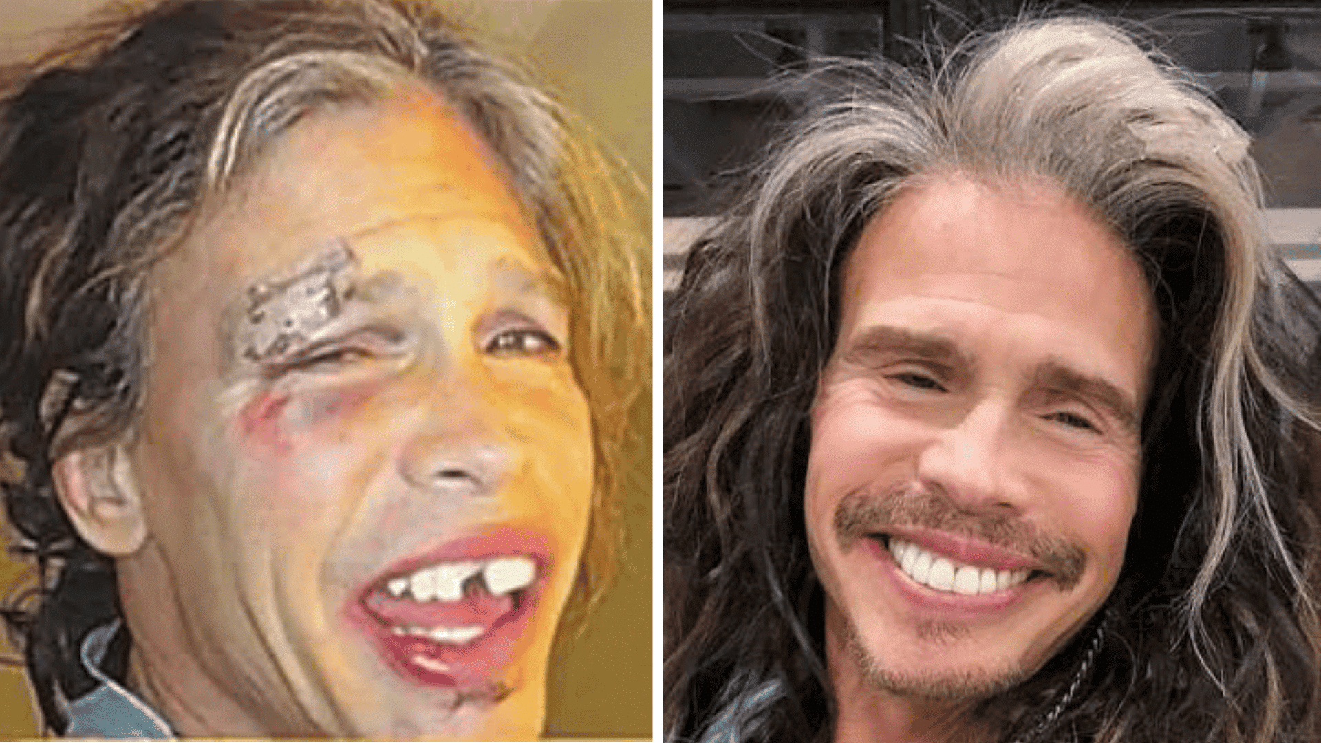 Steven Tyler before and after dental appearance comparison showing changes in his smile and teeth.