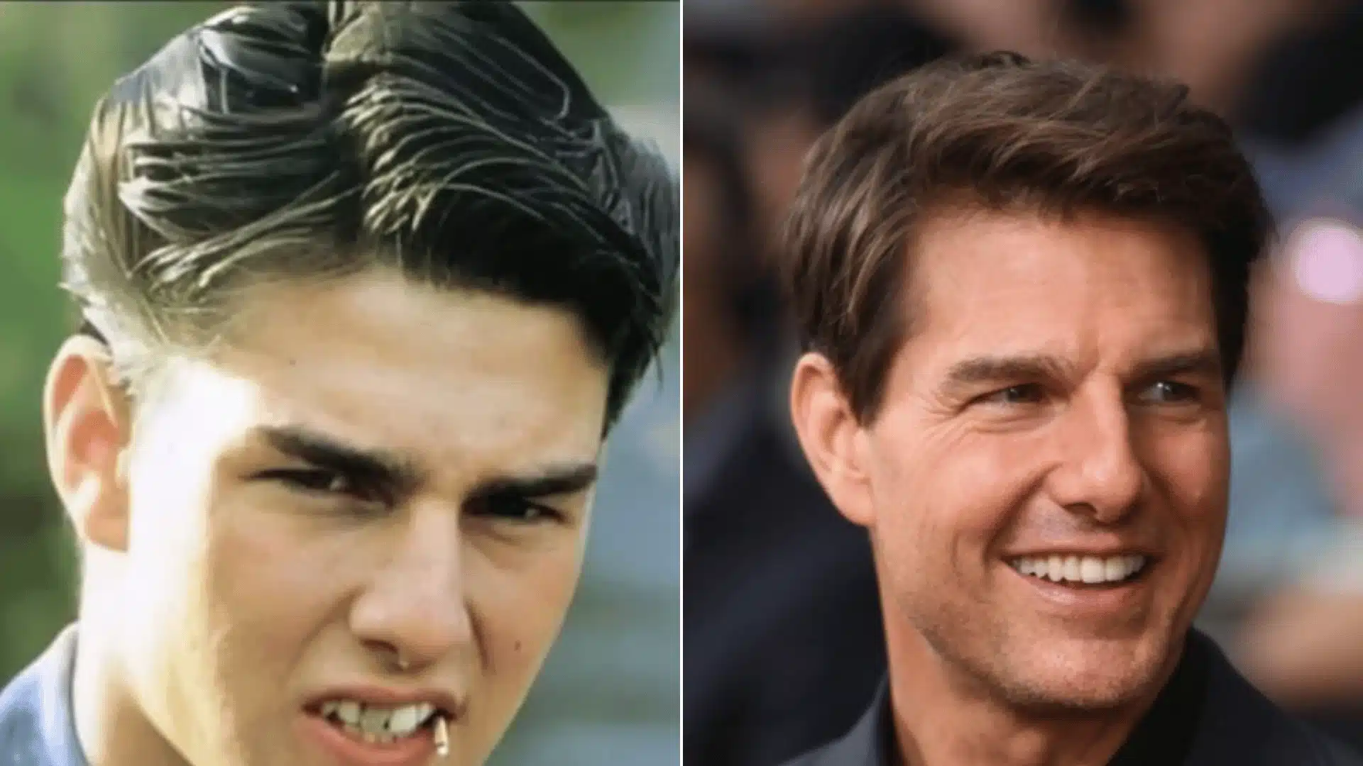 Portraits of Tom Cruise showing irregular front teeth, an uneven dental midline, and a straighter smile over time