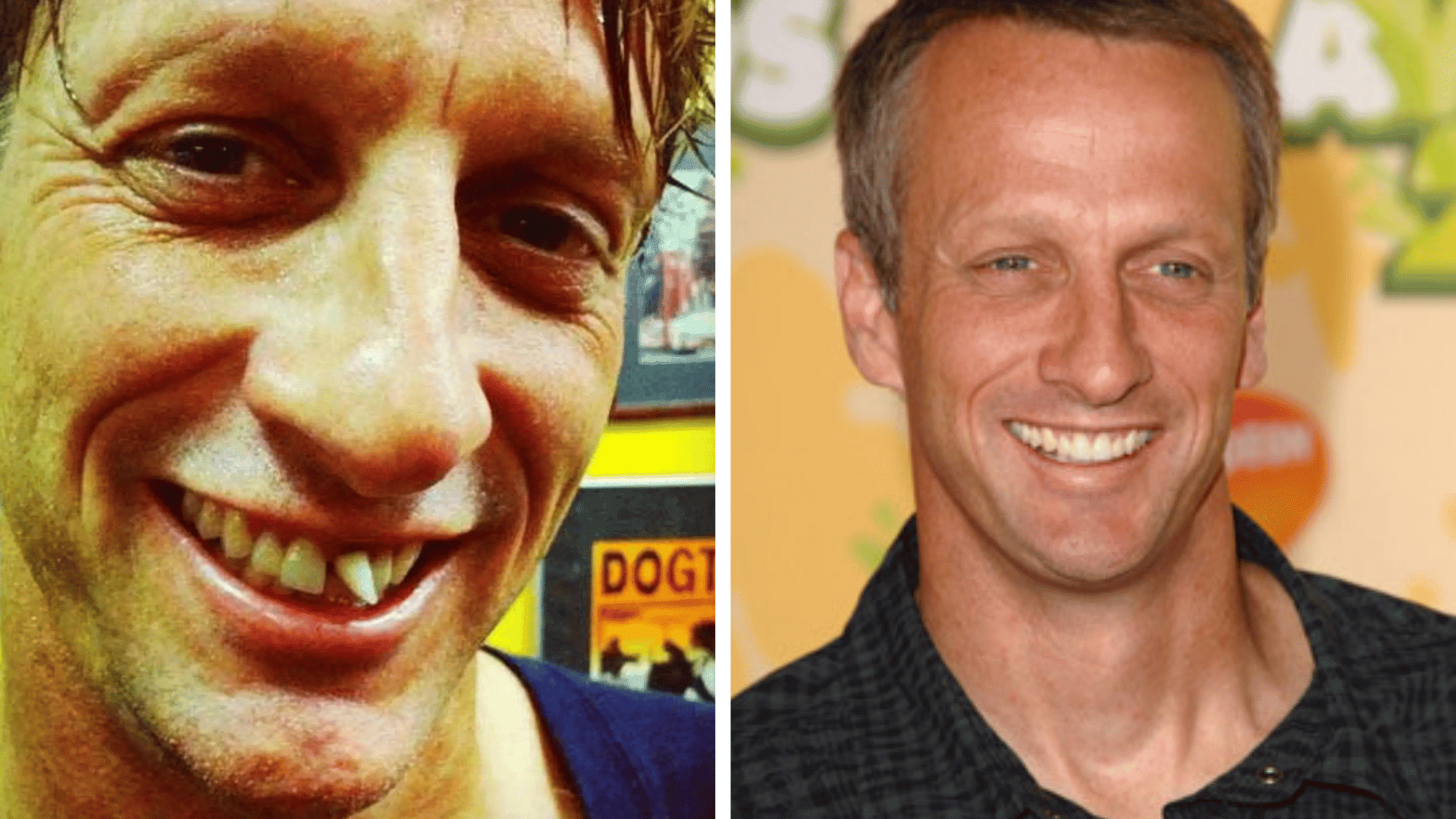 Tony Hawk before and after dental appearance comparison showing changes in his smile and teeth.