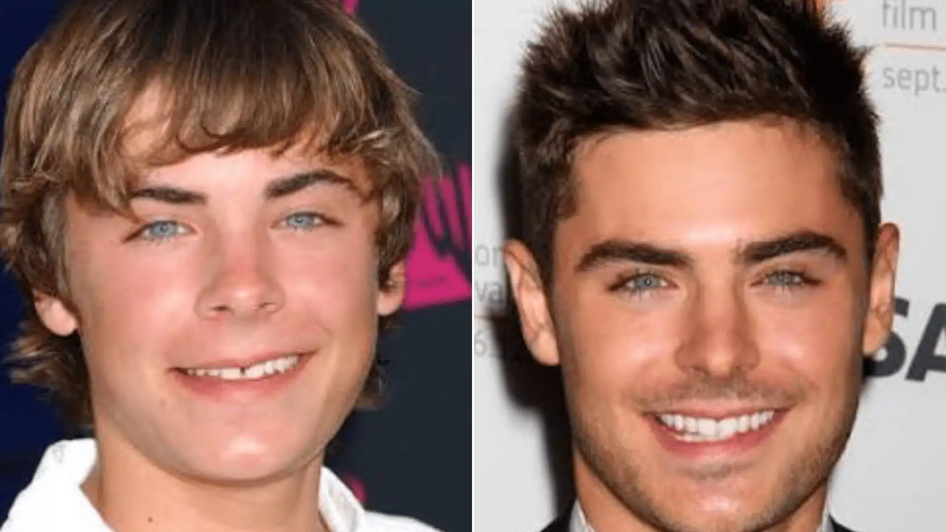 Zac Efron celebrity teeth before and after, showing changes in tooth spacing, color, shape, and alignment
