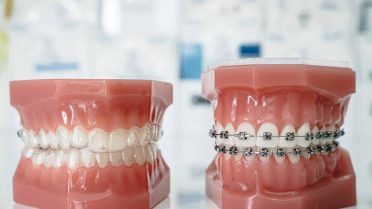 The Real Cost of a Perfect Smile: Comparing the Long-Term Value of Braces